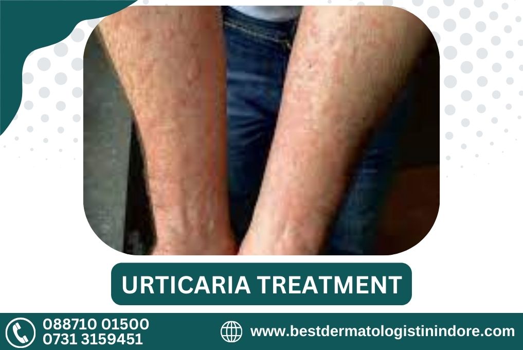 Best Skin Doctor for Urticaria Treatment in Indore